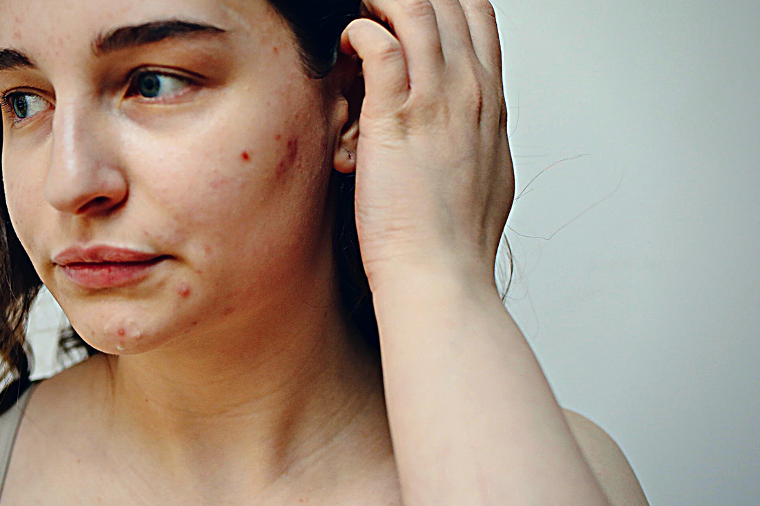 Understanding Stress-related Skin care woes and how a "Pause" can help